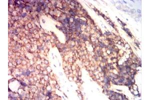 Immunohistochemical analysis of paraffin-embedded ewing sarcoma tissues using CD99 mouse mAb with DAB staining. (CD99 anticorps  (AA 1-185))