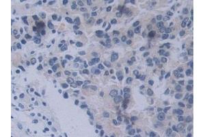 Detection of NRP2 in Human Prostate cancer Tissue using Polyclonal Antibody to Neuropilin 2 (NRP2)