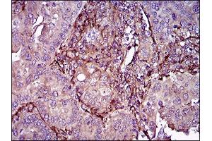 Immunohistochemical analysis of paraffin-embedded endometrial cancer tissues using THY1 mouse mAb with DAB staining.