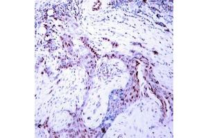 Immunohistochemical analysis of paraffin-embedded human breast carcinoma tissue using Progesterone Receptor(Phospho-Ser190) Antibody. (Progesterone Receptor anticorps  (pSer190))