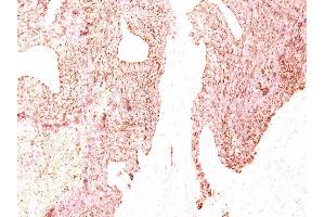 Formalin-fixed, paraffin-embedded human Small Cell Lung Carcinoma stained with Chromogranin A Monoclonal Antibody (LK2H10) (Chromogranin A anticorps)
