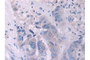 Detection of IL2 in Human Breast cancer Tissue using Polyclonal Antibody to Interleukin 2 (IL2) (IL-2 anticorps  (AA 21-153))