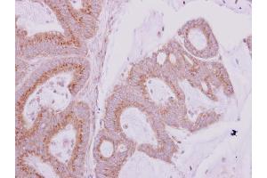IHC-P Image GBF1 antibody [N1], N-term detects GBF1 protein at cytoplasm on human colon carcinoma by immunohistochemical analysis.