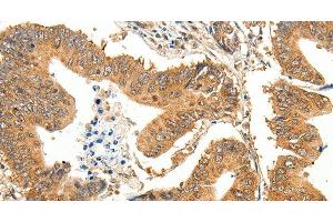 Immunohistochemistry of paraffin-embedded Human colon cancer using SLC32A1 Polyclonal Antibody at dilution of 1:35 (SLC32A1 anticorps)