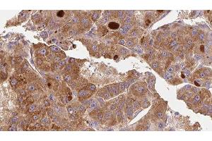 ABIN6276739 at 1/100 staining Human liver cancer tissue by IHC-P. (CD11b anticorps  (Internal Region))