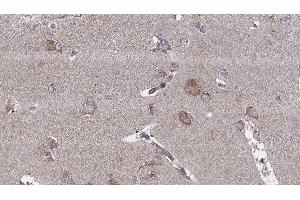 ABIN6276537 at 1/100 staining Human brain cancer tissue by IHC-P. (Doublecortin anticorps  (Internal Region))
