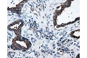 Immunohistochemical staining of paraffin-embedded Adenocarcinoma of colon tissue using anti-SRRmouse monoclonal antibody. (SRR anticorps)