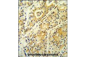 Formalin-fixed and paraffin-embedded human prostate carcinoma reacted with MGST2 Antibody ,which was peroxidase-conjugated to the secondary antibody, followed by DAB staining. (MGST2 anticorps  (C-Term))