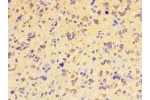 Immunohistochemistry of paraffin-embedded human glioma using ABIN7155399 at dilution of 1:100 (HIST1H2BD anticorps  (AA 2-57))
