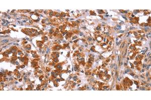 Immunohistochemistry of paraffin-embedded Human thyroid cancer tissue using GLMN Polyclonal Antibody at dilution 1:40 (GLMN anticorps)