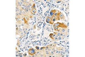 Immunohistochemistry of paraffin embedded human lung cancer using Cdcp1 (ABIN7073600) at dilution of 1:300 (400x lens) (CDCP1 anticorps)