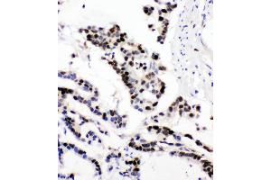 Anti-MCM6 antibody, IHC(P) IHC(P): Human Intestinal Cancer Tissue