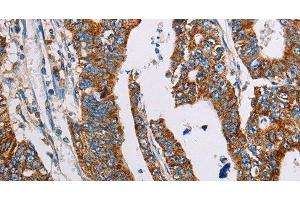Immunohistochemistry of paraffin-embedded Human gasrtic cancer tissue using ALG2 Polyclonal Antibody at dilution 1:35