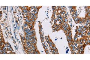 Immunohistochemistry of paraffin-embedded Human gasrtic cancer tissue using ALG2 Polyclonal Antibody at dilution 1:35 (ALG2 anticorps)