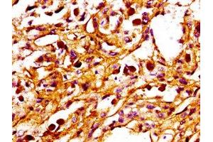 IHC image of ABIN7165944 diluted at 1:100 and staining in paraffin-embedded human melanoma performed on a Leica BondTM system. (PPM1F anticorps  (AA 1-76))