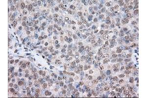 Immunohistochemical staining of paraffin-embedded Human colon tissue using anti-TACC3 mouse monoclonal antibody. (TACC3 anticorps)