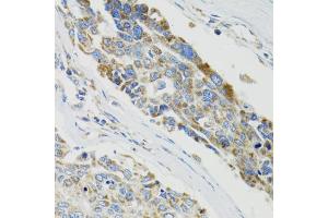 Immunohistochemistry of paraffin-embedded human liver cancer using SH2B1 Antibody (ABIN1876744) at dilution of 1:100 (40x lens). (SH2B1 anticorps)