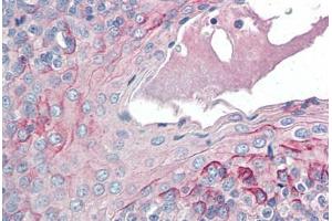 Human Tonsil (formalin-fixed, paraffin-embedded) stained with CCR6 antibody ABIN337207 at 5 ug/ml followed by biotinylated anti-goat IgG secondary antibody ABIN481715, alkaline phosphatase-streptavidin and chromogen. (CCR6 anticorps  (AA 18-46))
