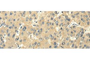 Immunohistochemistry of paraffin-embedded Human liver cancer using PMP2 Polyclonal Antibody at dilution of 1/25 (PMP2 anticorps)