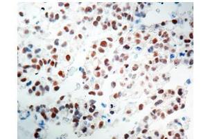 Formalin fixed paraffin embedded Testicular Seminoma stained with OCT4 antibody Cat. (OCT4 anticorps)