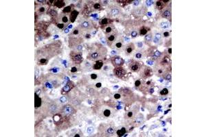 Immunohistochemical analysis of APE1 staining in human liver cancer formalin fixed paraffin embedded tissue section.