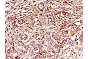 Immunohistochemistry of paraffin-embedded human pancreatic cancer using ABIN7150756 at dilution of 1:100 (DUSP19 anticorps  (AA 1-217))
