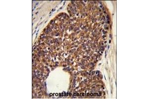 Formalin-fixed and paraffin-embedded human prostate carcinoma reacted with MTBP Antibody (C-term), which was peroxidase-conjugated to the secondary antibody, followed by DAB staining. (MTBP anticorps  (C-Term))