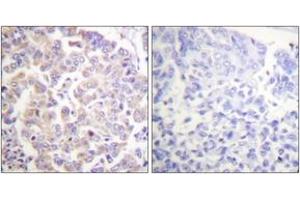 Immunohistochemistry analysis of paraffin-embedded human breast carcinoma, using APC1 (Phospho-Ser688) Antibody. (APC1 anticorps  (pSer688))