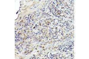 Immunohistochemistry of paraffin-embedded human tonsil using IL6R Rabbit pAb (ABIN3015521, ABIN3015522, ABIN3015523, ABIN1680455 and ABIN6218635) at dilution of 1:50 (40x lens). (IL-6 Receptor anticorps  (AA 20-320))