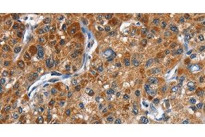 Immunohistochemistry of paraffin-embedded Human liver cancer tissue using DRAK2 Polyclonal Antibody at dilution 1:40 (DRAK2 anticorps)