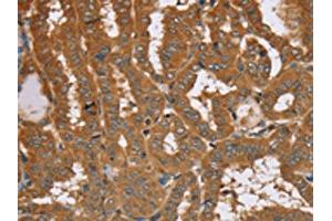 The image on the left is immunohistochemistry of paraffin-embedded Human thyroid cancer tissue using ABIN7192090(RAB14 Antibody) at dilution 1/40, on the right is treated with synthetic peptide. (RAB14 anticorps)