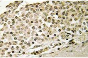 Immunohistochemistry (IHC) analyzes of Cerebral 1 antibody in paraffin-embedded human breast carcinoma tissue. (APP anticorps)