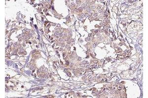 ABIN6267565 at 1/100 staining human Breast carcinoma tissue sections by IHC-P.