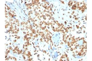 Formalin-fixed, paraffin-embedded human Breast Carcinoma stained with Emerin Mouse Monoclonal Antibody (EMD/2167). (Emerin anticorps  (AA 56-167))