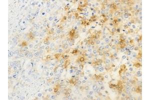 ABIN6263736 and ABIN6266891 at 1/100 staining human prostate carcinoma by IHC-P. (NRIP2 anticorps  (N-Term))