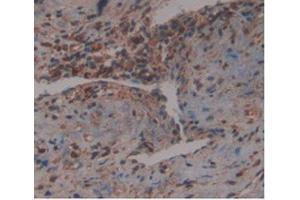 IHC-P analysis of Human Prostate Gland Cancer Tissue, with DAB staining. (GDF3 anticorps  (AA 251-364))