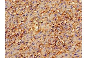 Immunohistochemistry of paraffin-embedded human liver cancer using ABIN7144268 at dilution of 1:100
