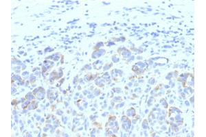 Formalin-fixed, paraffin-embedded human Melanoma stained with TYRP1 MAB (SPM611) (Tyrosinase-Related Protein 1 anticorps)