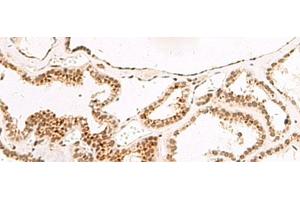Immunohistochemistry of paraffin-embedded Human thyroid cancer tissue using DGCR6L Polyclonal Antibody at dilution of 1:65(x200) (DGCR6L anticorps)