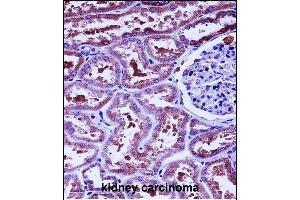 HTRA2 Antibody (N-term) (ABIN657628 and ABIN2846624) immunohistochemistry analysis in formalin fixed and paraffin embedded human kidney carcinoma followed by peroxidase conjugation of the secondary antibody and DAB staining.