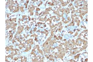 Formalin-fixed, paraffin-embedded human Pituitary stained with Growth Hormone Recombinant Mouse Monoclonal Antibody (rGH/1450). (Recombinant Growth Hormone 1 anticorps  (AA 58-187))
