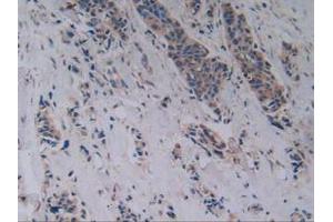 IHC-P analysis of Human Breast Cancer Tissue, with DAB staining. (RANKL anticorps  (AA 79-247))