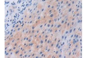 IHC-P analysis of Human Liver cancer Tissue, with DAB staining. (PIK3CB anticorps  (AA 807-1070))
