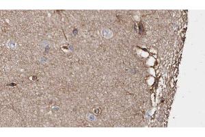 ABIN6279059 at 1/100 staining Human brain cancer tissue by IHC-P. (ABLIM1 anticorps  (N-Term))