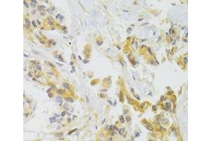 Immunohistochemistry of paraffin-embedded Human breast cancer using EIF4G1 Polyclonal Antibody at dilution of 1:100 (40x lens).