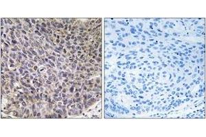 Immunohistochemistry analysis of paraffin-embedded human lung carcinoma tissue, using Cytochrome P450 4B1 Antibody. (CYP4B1 anticorps  (AA 141-190))