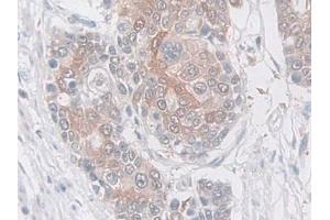 DAB staining on IHC-P; Samples: Human Prostate cancer Tissue (SERPINB5 anticorps  (AA 1-375))