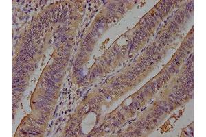 IHC image of ABIN7164836 diluted at 1:100 and staining in paraffin-embedded human colon cancer performed on a Leica BondTM system.