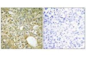 Immunohistochemistry analysis of paraffin-embedded human breast carcinoma tissue using ACVL1 antibody.