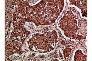Immunohistochemical analysis of paraffin-embedded human-lung-cancer, antibody was diluted at 1:200 (IMP3 anticorps  (AA 135-184))